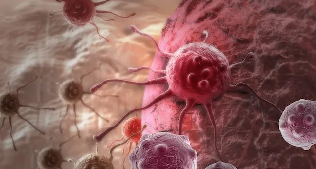 Adenocarcinoma: entenda tipos, classificação e formas de tratamento - Imagem do artigo