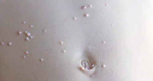Molusco contagioso: sinais, formas de contágio e tratamentos disponíveis - Imagem do artigo