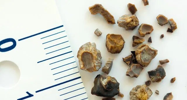 Pedra nos rins: sintomas, causas e tratamentos disponíveis - Imagem do artigo