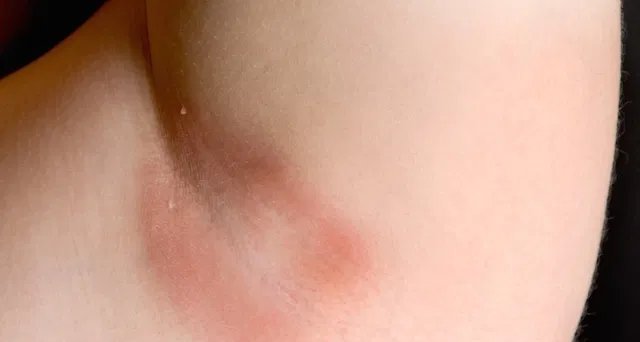 Intertrigo: inflamação nas dobras da pele causa coceira, vermelhidão e pode exigir pomadas antifúngicas - Imagem do artigo