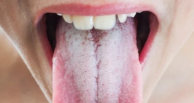 Língua branca: nove motivos frequentes e as orientações básicas de tratamento - Imagem do artigo