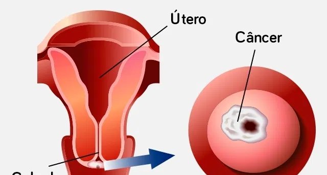 Infecção pelo HPV 16 e 18 é principal gatilho do câncer de colo de útero, aponta guia médico - Imagem do artigo