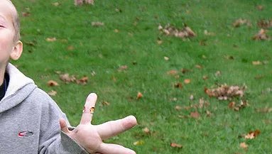 Doença genética rara provoca crescimento assimétrico de ossos e pele na Síndrome de Proteus - Imagem do artigo