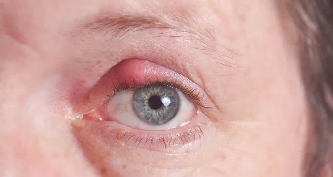 Seis motivos que podem provocar bolinha no olho e quais medidas tomar - Imagem do artigo