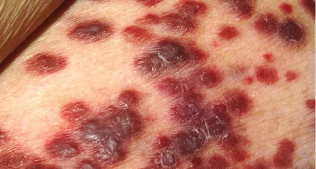 Púrpura de Henoch-Schönlein: inflamação dos vasos sanguíneos afeta principalmente crianças e pode atingir os rins - Imagem do artigo