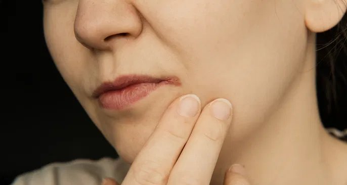 Queilite: inflamação nos lábios pode ter diversas causas e exige avaliação dermatológica - Imagem do artigo