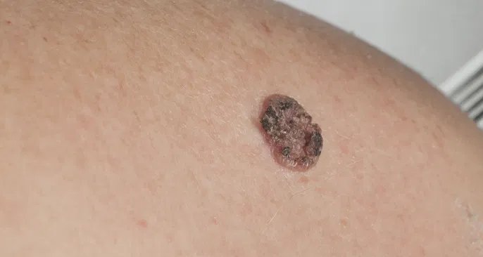Carcinoma de células escamosas: sinais, fatores de risco e opções de tratamento - Imagem do artigo