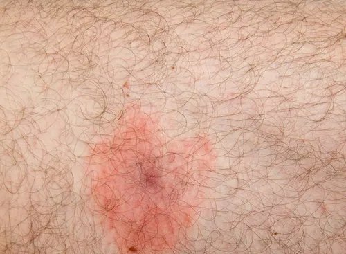 Doença de Lyme: infecção transmitida por carrapatos exige diagnóstico rápido e tratamento com antibióticos - Imagem do artigo