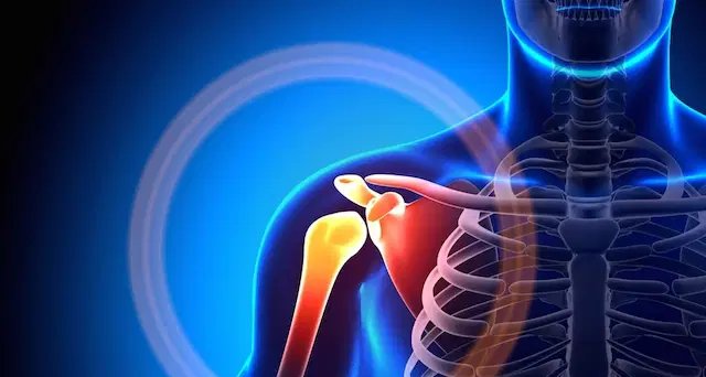 Capsulite adesiva: fisioterapia, medicamentos e outras opções para recuperar a mobilidade do ombro - Imagem do artigo