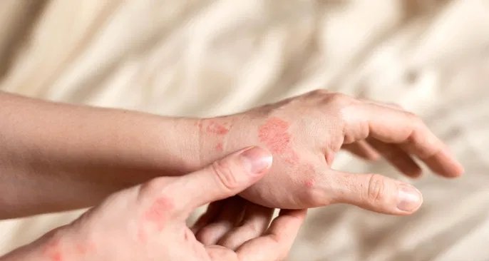 Erupção cutânea: saiba identificar sintomas, causas e opções de tratamento - Imagem do artigo