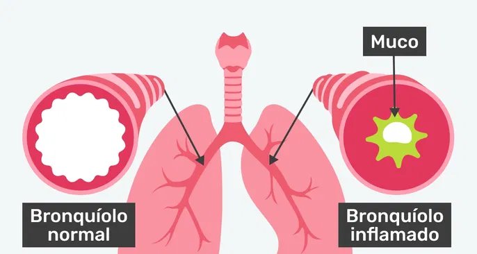 Bronquiolite: sintomas, causas, diagnóstico e opções de tratamento - Imagem do artigo