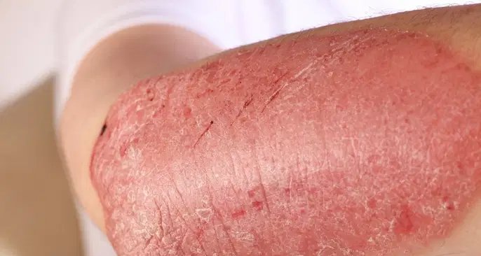 Psoríase não pega de pessoa para pessoa e exige acompanhamento dermatológico - Imagem do artigo