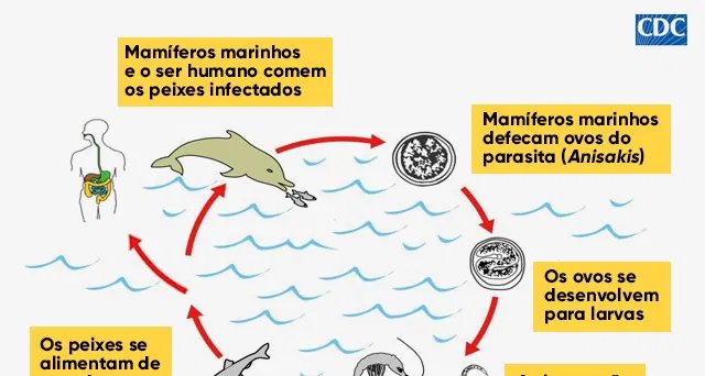 Anisaquíase: parasita do “verme do sushi” provoca dor intensa e pode ser retirado por endoscopia - Imagem do artigo